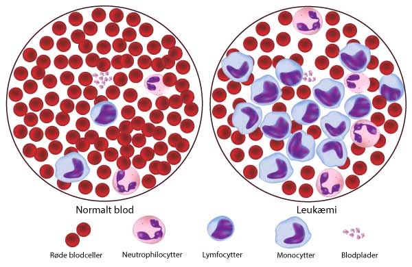 I forbindelse med kronisk leukæmi fortrænger de syge hvide blodceller langsomt de røde blodceller og de sunde hvide.